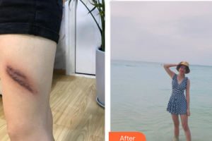 東莞市人民醫(yī)院醫(yī)學(xué)美容科廖旭鋒整形價格表附疤痕增生案例展示