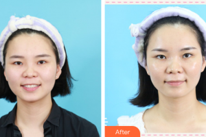 東莞東華醫(yī)院燒傷整形科劉玉琴整形價格表附激光美膚祛斑案例展示