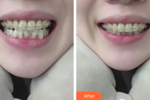 東莞美立方美容醫(yī)院楊文麗整形價格表附牙齒金屬矯正案例展示