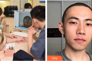 東莞美立方美容醫(yī)院徐霞整形價(jià)格表附種植發(fā)際線案例展示