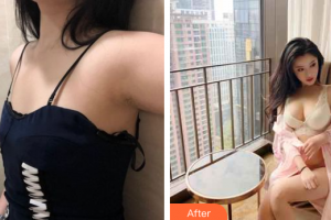 東莞美立方美容醫(yī)院李波整形價(jià)格表附假體隆胸案例展示