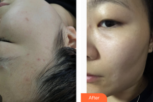 東莞百佳瑪麗亞婦產(chǎn)醫(yī)院何立整形價(jià)格表附祛斑案例展示