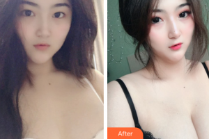 東莞百佳瑪麗亞婦產(chǎn)醫(yī)院金進(jìn)整形價(jià)格表附假體隆胸案例展示