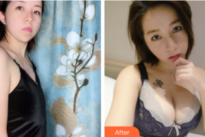 東莞百佳瑪麗亞婦產(chǎn)醫(yī)院柳宣惠整形價(jià)格表附假體隆胸案例展示