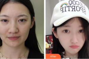 東莞韓美整形醫(yī)院金賢珠整形價(jià)格表附激光祛斑案例展示