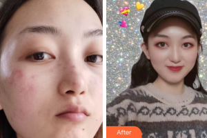 東莞美立方美容醫(yī)院王繼文整形價(jià)格表附超激光美膚+祛斑針案例展示