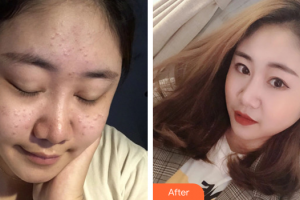 東莞韓美整形醫(yī)院趙德印主診醫(yī)師整形價(jià)格表附祛痘案例展示