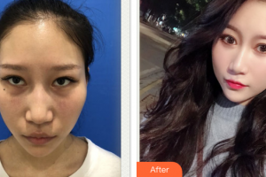 東莞瑞芙臣醫(yī)療美容門診部王貴賢整形價(jià)格表附激光去眼袋案例展示