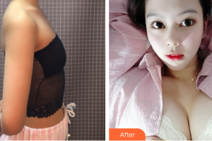 東莞華美醫(yī)療美容醫(yī)院劉正淵整形價(jià)格表附胸部整形案例展示