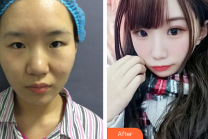 東莞非凡美容醫(yī)院顏江整形價(jià)格表附眼部綜合案例展示