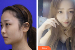 東莞寶格麗醫(yī)療美容門診部胡峻齊整形價(jià)格表附鼻子塑造案例展示