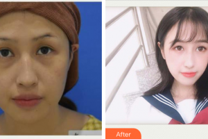 東莞君熠醫(yī)療美容診所胥恒整形價(jià)格表附激光去眼袋案例展示