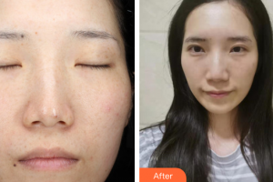 東莞寶格麗醫(yī)療美容門診部林曉娟整形價(jià)格表附激光祛斑案例展示