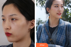 東莞市第六人民醫(yī)院醫(yī)療美容中心袁鐘岱整形價(jià)格表附超激光美膚嫩膚案例展示