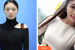 東莞市第六人民醫(yī)院醫(yī)療美容中心羅海燕整形價(jià)格表附自體脂肪隆胸案例展示