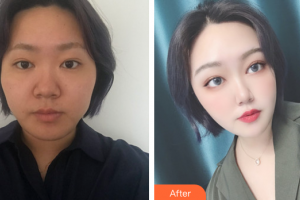 東莞美立方美容醫(yī)院謝子才整形價(jià)格表附面部埋線提升提升案例展示