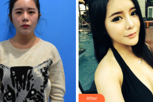 東莞同濟(jì)光華醫(yī)院口腔科戴新明整形價(jià)格表附自體脂肪隆胸案例展示