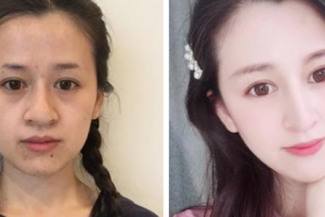 武漢明星醫(yī)學(xué)整形美容醫(yī)院李欣融整形價(jià)格表附激光祛斑案例展示