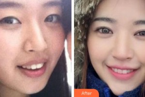 河南省整形美容研究中心范學(xué)文整形價格表附牙齒矯正案例展示