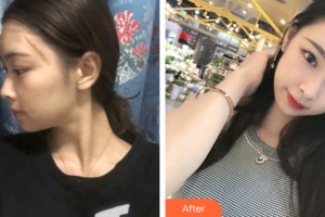 河南大學(xué)附屬南石醫(yī)院燒傷整形美容中心李天宇整形價格表附皮膚美容案例展示