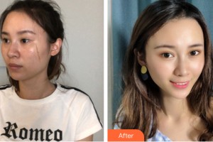 河南大學(xué)附屬南石醫(yī)院燒傷整形美容中心閆靜整形價(jià)格表附皮膚美容案例展示