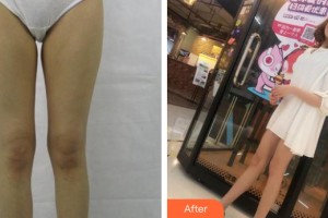 河南整形美容醫(yī)院劉乾坤整形價(jià)格表附大腿吸脂案例展示