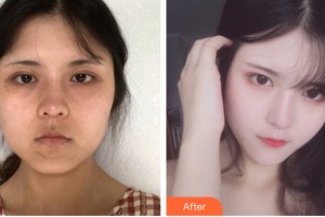 河南省整形美容研究中心湯芳芳整形價(jià)格表附皮膚美容案例展示