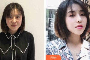 河南省整形美容研究中心王麗娟整形價格表附皮膚美容案例展示