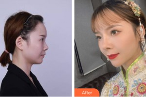 武警河南省總隊醫(yī)院激光整形中心解邦杰整形價格表附鼻部手術(shù)案例展示