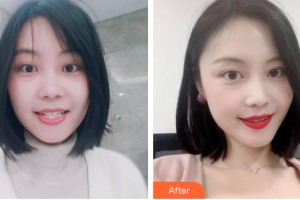 武警河南省總隊醫(yī)院激光整形中心劉紅整形價格表附牙齒矯正案例展示