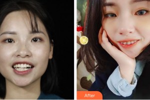 海南泰康拜博口腔醫(yī)院黃超整形價(jià)格表附牙齒矯正案例展示