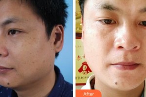湖北武警總隊(duì)醫(yī)院醫(yī)學(xué)美容中心付俊俐整形價(jià)格表附祛斑案例展示