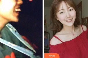 湖北恩施咿呀牙科診所丁小璐整形價(jià)格表附隱形托槽矯正案例展示