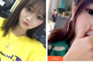 湖北恩施咿呀牙科診所晏峰主任醫(yī)師整形價(jià)格表附超聲波潔牙案例展示