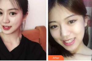 廣東醫(yī)學(xué)院附屬醫(yī)院整形外科羅少軍整形價格表附面部吸脂案例展示