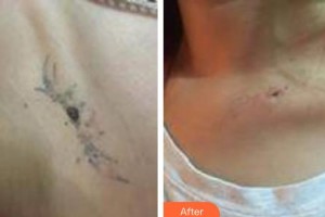 武警廣東總隊醫(yī)院整形美容中心韓業(yè)威整形價格表附激光去紋身案例展示