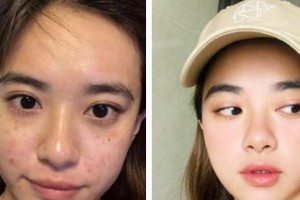 廣東藥學(xué)院附屬第一醫(yī)院激光整形美容外科楊曙整形價格表附激光祛斑案例展示