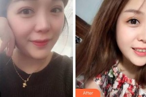 廣東藥科大學(xué)附屬第三醫(yī)院整形美容科馮澤宇整形價格表附牙齒隱形矯正案例展示