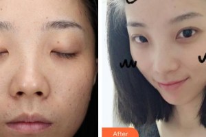 廣東藥科大學(xué)附屬第三醫(yī)院整形美容科巫尾英整形價格表附激光點(diǎn)痣案例展示