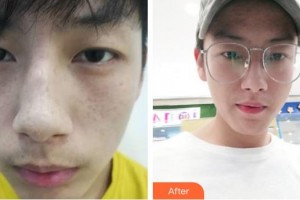 云南華美美萊美容醫(yī)院蘭云整形價(jià)格表附祛斑祛痣案例展示