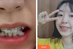 云南華美美萊美容醫(yī)院馮銳整形價(jià)格表附牙齒陶瓷矯正案例展示