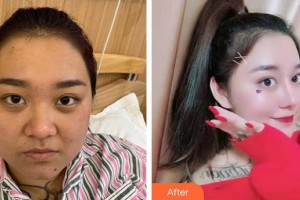 云南華美美萊美容醫(yī)院金永德整形價(jià)格表附鼻部綜合案例展示