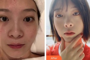 云南華美美萊美容醫(yī)院俞滿昌整形價(jià)格表附水氧活膚案例展示