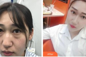 云南中醫(yī)學(xué)院附設(shè)中醫(yī)醫(yī)院整形美容中心張巍巍整形價(jià)格表附激光去眼袋案例展示