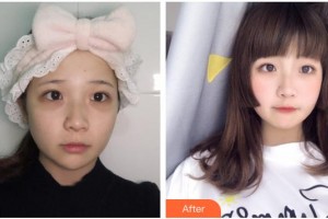 云南中醫(yī)學(xué)院附設(shè)中醫(yī)醫(yī)院整形美容中心王竹琴整形價(jià)格表附眼部綜合案例展示