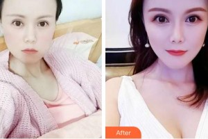 武警云南省邊防總隊(duì)醫(yī)院整形美容中心王強(qiáng)整形價(jià)格表附假體隆胸案例展示