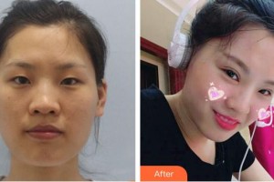 武警云南省邊防總隊(duì)醫(yī)院整形美容中心石林整形價(jià)格表附切開雙眼皮案例展示