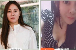 云南銅雀臺(tái)整形美容醫(yī)院林沸騰整形價(jià)格表附激光溶脂案例展示