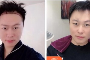 武警云南省邊防總隊(duì)醫(yī)院整形美容中心刁永鋒整形價(jià)格表附種植發(fā)際線案例展示