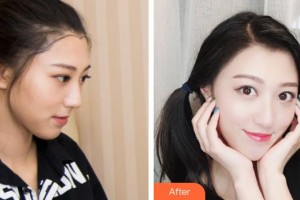 云南銅雀臺(tái)整形美容醫(yī)院趙唱熙整形價(jià)格表附種植發(fā)際線案例展示